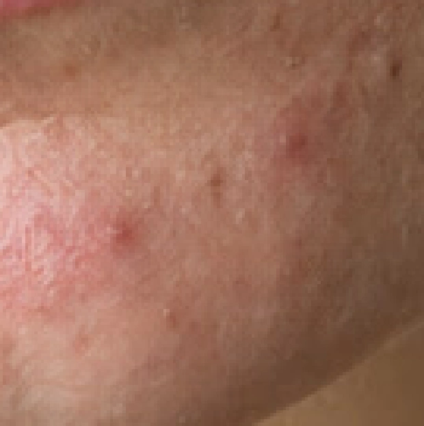 Tre imperfezioni del mento cerchiate, con il bersaglio di destra spostato sopra e a destra della lentiggine vicina