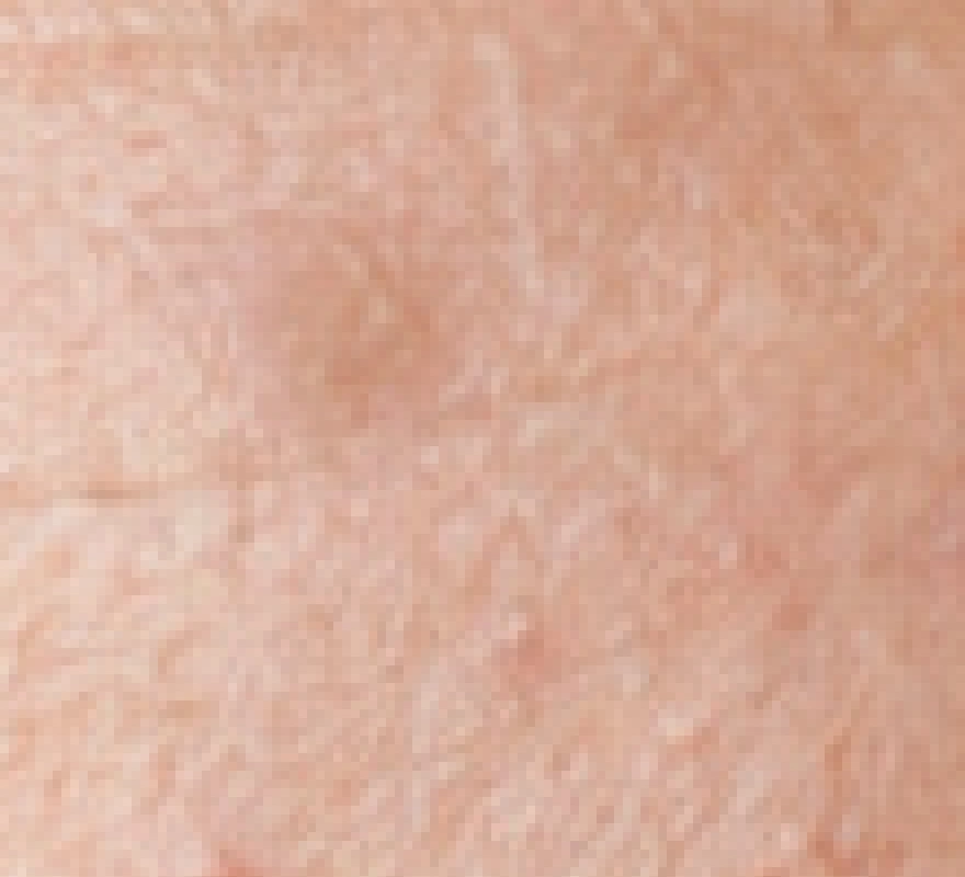 Un disco beige ben visibile dove il Timbro clone ha copiato il prelievo più scuro sopra l’imperfezione rosa della fronte