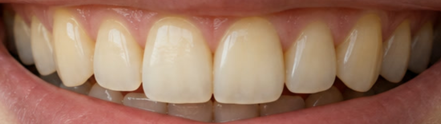 L’intera arcata superiore prima dello sbiancamento, con lo smalto caldo dalla linea curva della gengiva fino alle punte dei denti