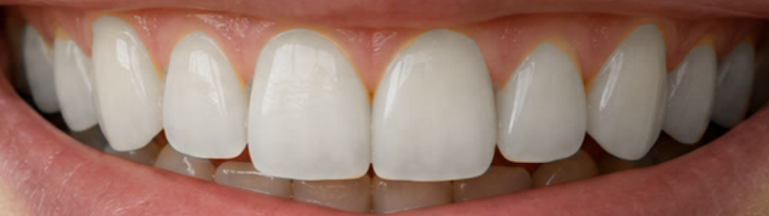 La stessa arcata superiore dopo lo sbiancamento, con lo smalto coperto compresi il terzo vicino alla gengiva e i bordi, mentre gengive e denti inferiori mantengono il loro colore